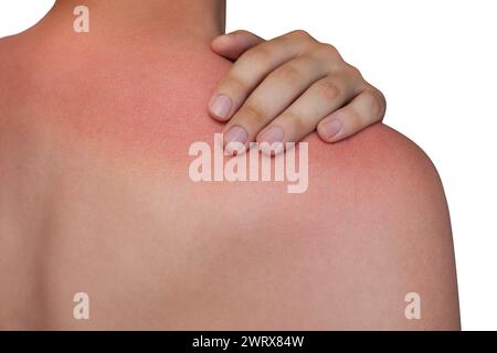 Un homme avec une peau rougie et démangeante après un coup de soleil sur fond blanc isolé. Soin de la peau et protection contre les rayons ultraviolets du soleil. Banque D'Images