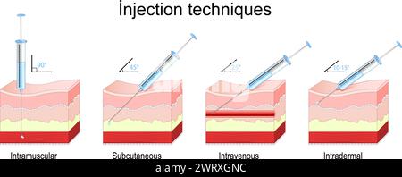 Méthodes d'injection. coupe transversale d'une peau humaine avec seringue. Angles d'insertion de l'aiguille pour intramusculaire, sous-cutanée, intraveineuse et intradermique i Illustration de Vecteur