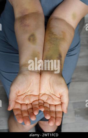 Main de femme avec ecchymose d'accident de voiture Banque D'Images