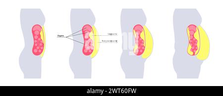 Schéma de la graisse viscérale, illustration. La graisse du ventre entoure les organes internes dans la cavité abdominale. Banque D'Images