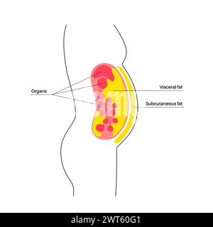 Schéma de la graisse viscérale, illustration. La graisse du ventre entoure les organes internes dans la cavité abdominale. Banque D'Images