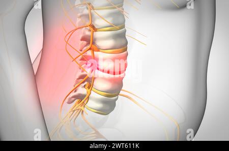 Hernie discale, illustration. Banque D'Images