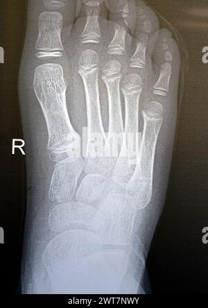 La radiographie simple du pied droit d'un enfant de 9 ans montre une étude de radiographie osseuse pédiatrique normale, avec des centres d'ossification d'un enfant normal en croissance avec Banque D'Images