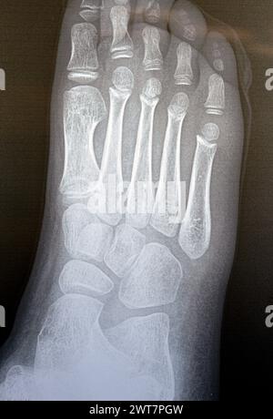 La radiographie simple du pied droit d'un enfant de 9 ans montre une étude de radiographie osseuse pédiatrique normale, avec des centres d'ossification d'un enfant normal en croissance avec Banque D'Images