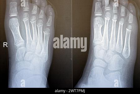 La radiographie simple du pied droit d'un enfant de 9 ans montre une étude de radiographie osseuse pédiatrique normale, avec des centres d'ossification d'un enfant normal en croissance avec Banque D'Images