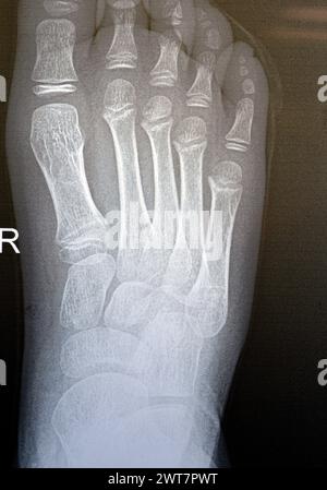 La radiographie simple du pied droit d'un enfant de 9 ans montre une étude de radiographie osseuse pédiatrique normale, avec des centres d'ossification d'un enfant normal en croissance avec Banque D'Images