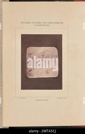 Plaque de zona. Arthur de Montmeja, photographe (français, né en 1841) négatif vers 1867, impression 1882 vue rapprochée de cloques provenant d'une éruption de zona sur la peau humaine. (Recto, monture) haut au centre, imprimé à l'encre noire : 'MALADIES CUTANÉES IMFLAMMATOIRES et / ACCIDENTELLES' en bas à gauche, imprimé à l'encre noire : 'A. de Montmeja' en bas au centre, imprimé à l'encre noire : 'PLAQUE DE ZONA' en bas à droite, imprimé à l'encre noire : 'ad naturam fecit' Banque D'Images