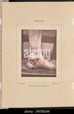 Syphilide ulcéreuse perforante. Arthur de Montmeja, photographe (français, né en 1841) négatif vers 1867, impression 1882 vue d'un pied avec lésions ulcéreuses de syphilis couvrant la cheville. (Recto, monture) haut centre, imprimé à l'encre noire : 'SYPHILIDES' en bas à gauche, imprimé à l'encre noire : 'A. de Montmeja' en bas centre, imprimé à l'encre noire : 'SYPHILIDE ULCÉREUSE PERFORANTE' en bas à droite, imprimé à l'encre noire : 'ad naturam fecit' Banque D'Images