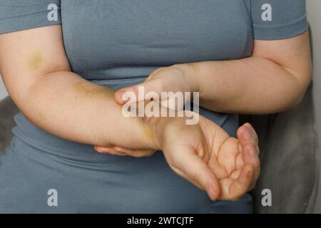 Main humaine avec ecchymose d'accident de voiture Banque D'Images