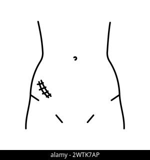 Icône de ligne d'incision McBurney. Incisions abdominales. Elément isolé par vecteur. Contour modifiable. Illustration de Vecteur