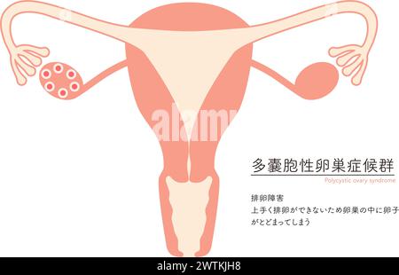 Illustration schématique du syndrome des ovaires polykystiques (trouble de l'ovulation), anatomie de l'utérus et des ovaires - traduction : échec de l'ovulation Failur Illustration de Vecteur