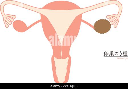 Illustration schématique des kystes ovariens, anatomie de l'utérus et des ovaires, illustration vectorielle Illustration de Vecteur