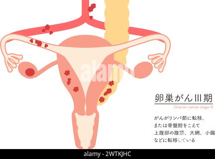 Illustration schématique du cancer de l'ovaire de stade III, anatomie de l'utérus et des ovaires, anatomie de l'utérus et des ovaires - traduction : le cancer a Illustration de Vecteur