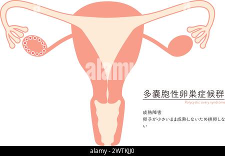 Illustration schématique du syndrome des ovaires polykystiques (trouble de la maturation), anatomie de l'utérus et des ovaires - traduction : échec de maturation Illustration de Vecteur