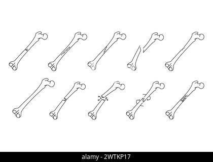 Icônes de ligne de fracture osseuse définies. Elément isolé par vecteur. Contour modifiable. Illustration de Vecteur
