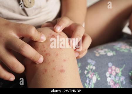 Vue rapprochée d’un garçon montrant son genou infecté par une maladie des mains, des pieds et de la bouche ou une HFMD provenant d’un entérovirus ou d’un virus coxsackie, Banque D'Images