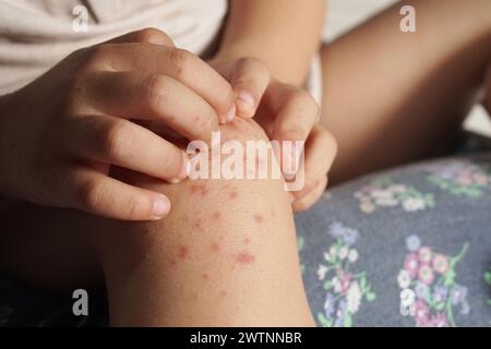 Vue rapprochée d'un enfant qui se gratte le genou en raison d'une infection par une maladie des mains, des pieds et de la bouche ou une HFMD provenant d'un entérovirus ou d'une coxs Banque D'Images