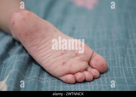 Vue rapprochée des pieds d'un enfant infectés par une maladie des mains et de la bouche ou HFMD provenant d'un entérovirus ou d'un virus coxsackie, zoom shot. Banque D'Images