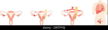 Illustration schématique du cancer de l'ovaire de stade I, anatomie de l'utérus et des ovaires, anatomie de l'utérus et des ovaires - traduction : le cancer est con Illustration de Vecteur