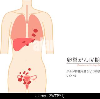 Illustration schématique du cancer de l'ovaire stade IV, anatomie de l'utérus et des ovaires, anatomie de l'utérus et des ovaires - traduction : le cancer a s Illustration de Vecteur