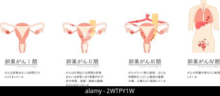 Illustration schématique du cancer de l'ovaire de stade I, anatomie de l'utérus et des ovaires, anatomie de l'utérus et des ovaires - traduction : le cancer est con Illustration de Vecteur