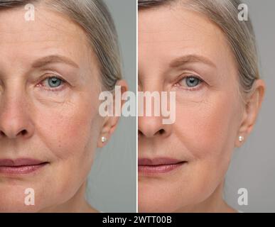 Modifications cutanées vieillissantes. Collage avec des photos de femme mature avant et après la procédure cosmétique sur fond gris, gros plan Banque D'Images