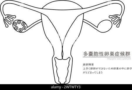 Illustration schématique du syndrome des ovaires polykystiques (trouble de l'ovulation), anatomie de l'utérus et des ovaires - traduction : échec de l'ovulation Failur Illustration de Vecteur