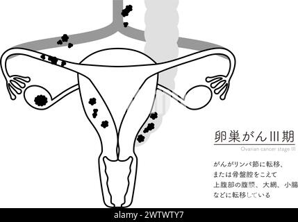 Illustration schématique du cancer de l'ovaire de stade III, anatomie de l'utérus et des ovaires, anatomie de l'utérus et des ovaires - traduction : le cancer a Illustration de Vecteur