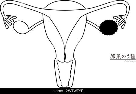 Illustration schématique des kystes ovariens, anatomie de l'utérus et des ovaires, illustration vectorielle Illustration de Vecteur