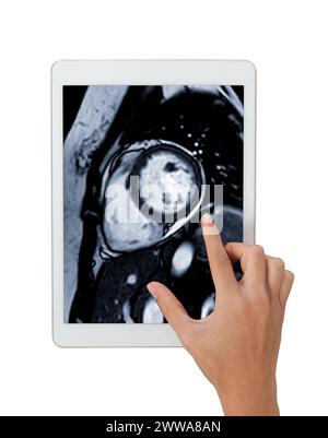 Les images IRM cardiaques sur tablette sont essentielles à l'évaluation de la santé cardiaque, à l'identification des anomalies cardiaques isolées sur fond blanc Banque D'Images