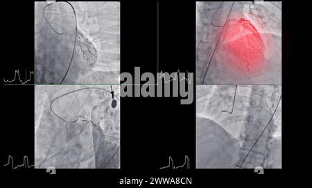 Le cathétérisme cardiaque est une procédure médicale utilisée pour examiner les vaisseaux sanguins du cœur. Banque D'Images