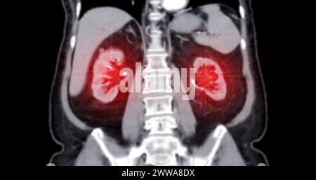 Tomodensitométrie de l'abdomen entier avec injection de produit de contraste en vue frontale. Banque D'Images