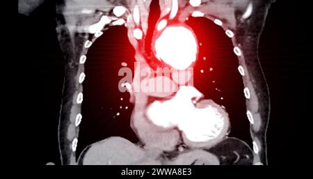 L'imagerie par angiographie par TDM de l'aorte entière la vue frontale affichant un anévrisme aortique fournit une évaluation complète pour un diagnostic précis et une planification du traitement. Banque D'Images