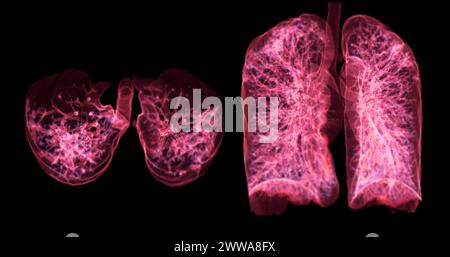 Une tomodensitométrie thoracique 3D affichant une lésion au niveau du lobe supérieur droit offre une visualisation détaillée, facilitant ainsi l'identification précise et le traitement Banque D'Images