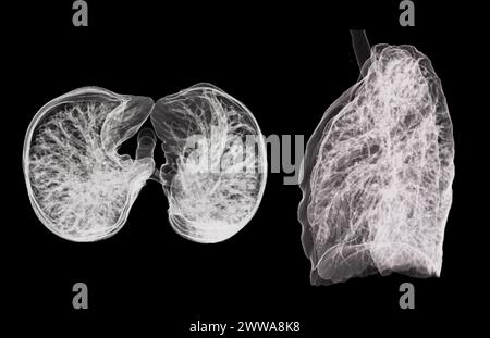 Une tomodensitométrie thoracique 3D affichant une lésion au niveau du lobe supérieur droit offre une visualisation détaillée, facilitant ainsi l'identification précise et le traitement Banque D'Images