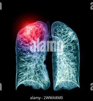 Une tomodensitométrie thoracique 3D affichant une lésion au niveau du lobe supérieur droit offre une visualisation détaillée, facilitant ainsi l'identification précise et le traitement Banque D'Images