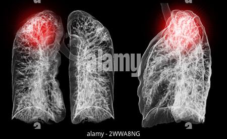 Une tomodensitométrie thoracique 3D affichant une lésion au niveau du lobe supérieur droit offre une visualisation détaillée, facilitant ainsi l'identification précise et le traitement Banque D'Images