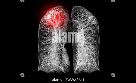 Une tomodensitométrie thoracique 3D affichant une lésion au niveau du lobe supérieur droit offre une visualisation détaillée, facilitant ainsi l'identification précise et le traitement Banque D'Images