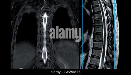 IRM rachis T-L ou thoraco-sacré technique T2 axiale et sagittale avec ligne de référence pour le diagnostic de compression médullaire. Banque D'Images