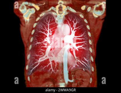 Le rendu 3D de l'aorte thoracique par TDM offre une visualisation détaillée, fournissant des informations claires sur l'anatomie aortique, la pathologie et les structures environnantes pour Banque D'Images