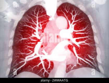Artère pulmonaire CTPA ou CTA. Cette technique d'imagerie offre une vue claire des artères pulmonaires, facilitant le diagnostic de l'embolie pulmonaire, des canaux Banque D'Images