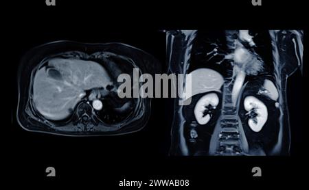 L'IRM de la vue frontale supérieure de l'abdomen est une technique d'imagerie non invasive qui fournit des images détaillées d'organes tels que le foie, le pancréas et les reins. Banque D'Images