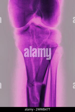 Fracture du genou (causée par un choc violent, causant un traumatisme ...