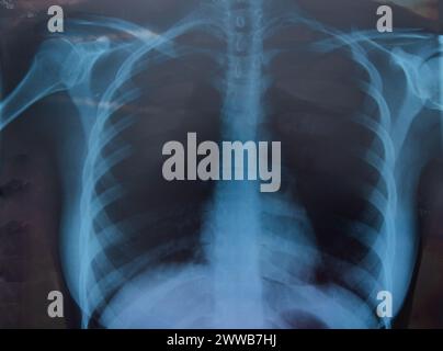 Radiographie de la femme pour examen de la poitrine et des poumons. Concept médical Banque D'Images