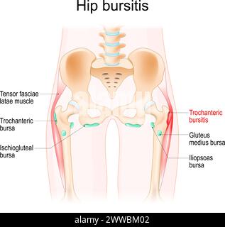 Bursite de la hanche. Muscles, bourses synoviales et os d'une hanche humaine. Bursite trochantérienne. Illustration vectorielle réaliste Illustration de Vecteur