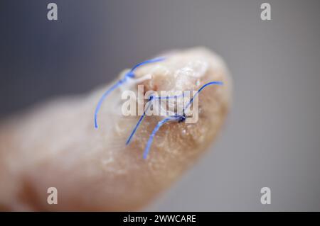 un-pouce-de-la-main-gauche-avec-ablation-chirurgicale-de-l-ongle-du