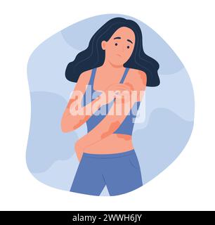 Femme avec de l'eczéma sur le corps pour l'illustration de concept de dermatologie Illustration de Vecteur