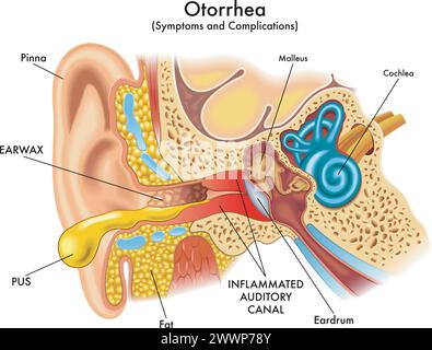 Illustration médicale de certains symptômes et complications de l'otorrhée, une pathologie qui affecte l'oreille, avec des annotations. Illustration de Vecteur
