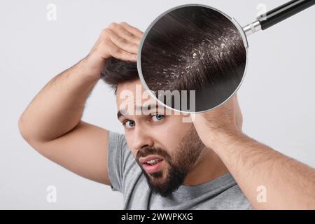 Homme souffrant de pellicules sur fond gris clair. Voir à travers la loupe sur les cheveux avec des flocons Banque D'Images