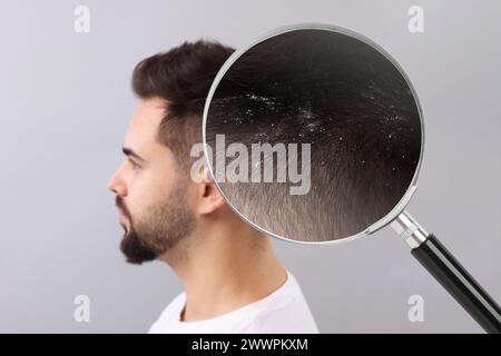 Homme souffrant de pellicules sur fond gris clair. Voir à travers la loupe sur les cheveux avec des flocons Banque D'Images